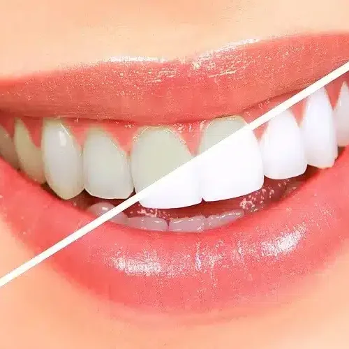 Clareamento-dental