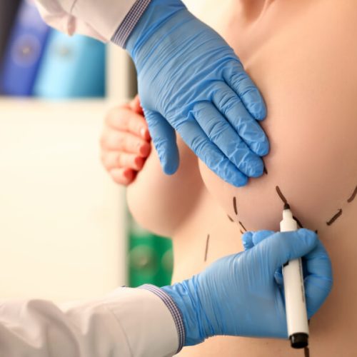 Mamoplastia-com-Pediculo-Central