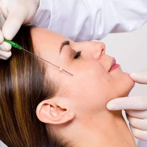 fios-bioestimulo-de-colageno