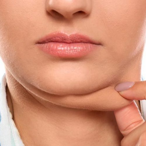 lipo-papada-1024x538-1